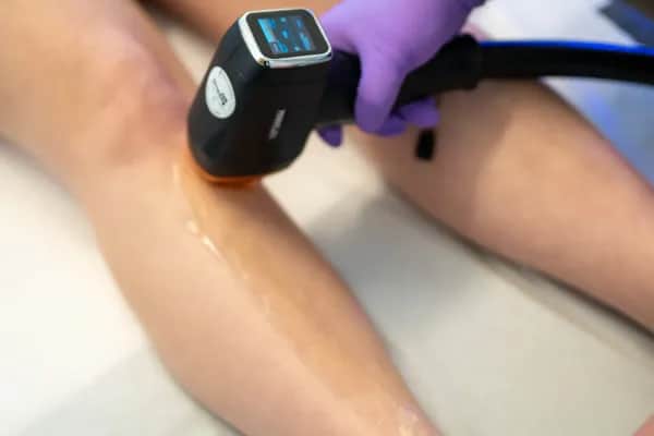 Dauerhafte Haarentfernung mit Laser in Linz - Glatte Haut ohne Rasur