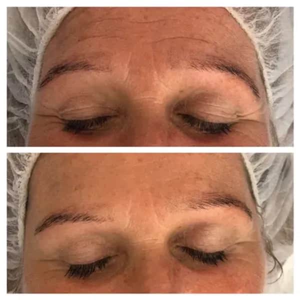 Hautstraffung mit Microneedling in Linz - Jetzt Termin sichern