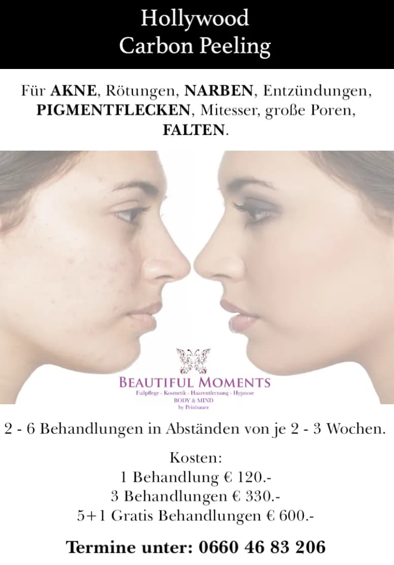 Erstklassige Carbon-Peeling Behandlung in Linz