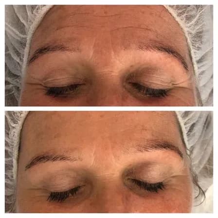 Hautstraffung mit Microneedling in Linz - Jetzt Termin sichern