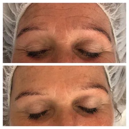 Hautstraffung mit Microneedling in Linz - Jetzt Termin sichern